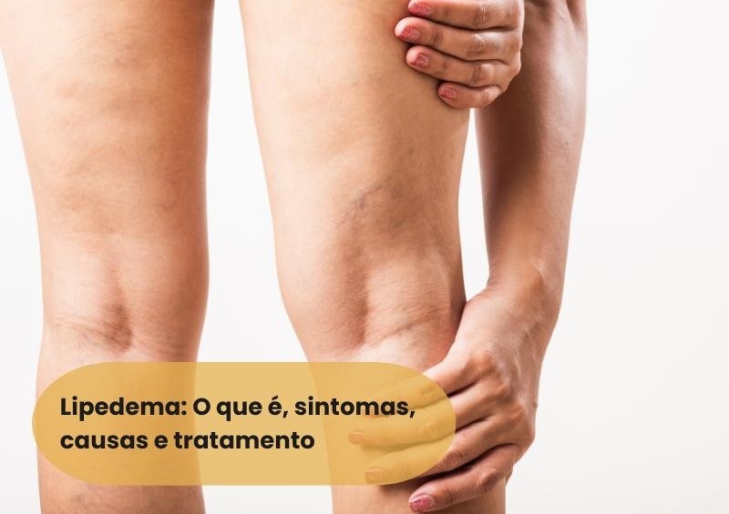 Lipedema: O que é, causa, sintomas e tratamento