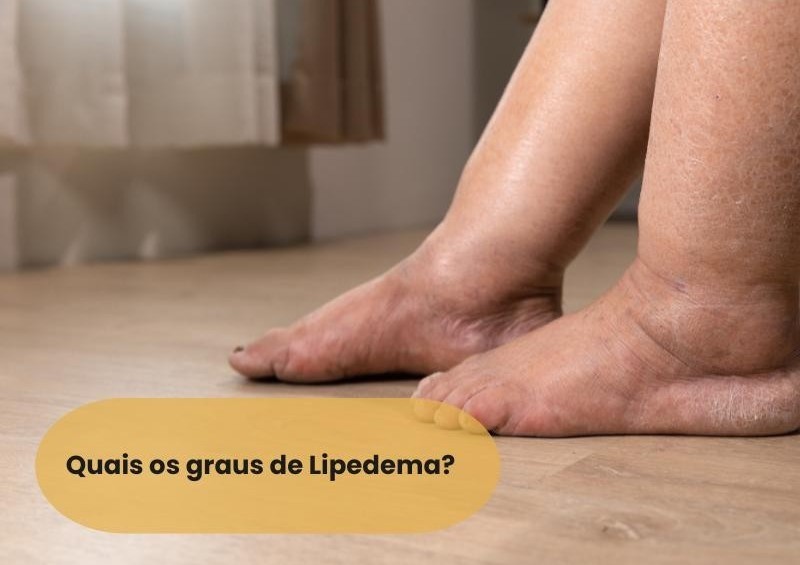 Quais os graus de lipedema?