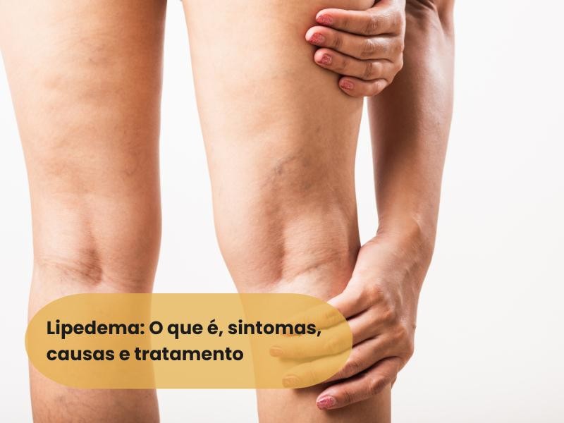 Lipedema: O que é, causa, sintomas e tratamento