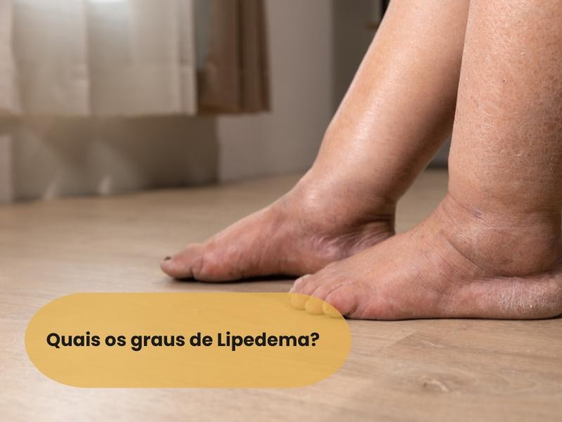 Quais os graus de lipedema?